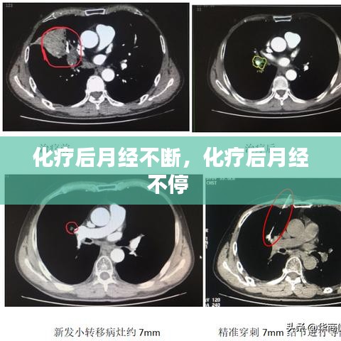 化疗后月经不断，化疗后月经不停 