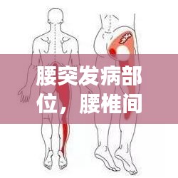 腰突发病部位，腰椎间盘突出常发部位 