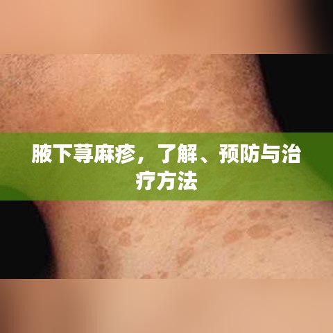腋下荨麻疹，了解、预防与治疗方法